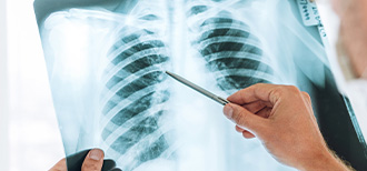 Lung Cancer and Asbestosis